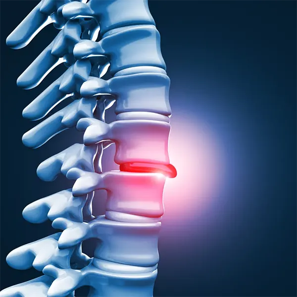 Disc Herniation Treatment Near Me in Oviedo, FL. Chiropractor For Disc Injury Pain Relief.